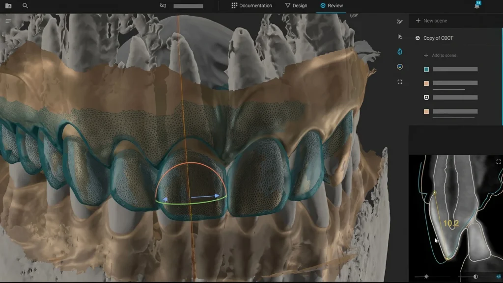Искусственный интеллект в стоматологии: как Digital Smile Design меняет подход к винирам?