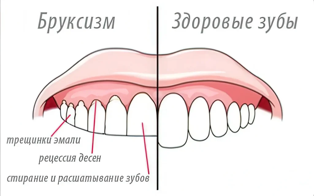Бруксизм