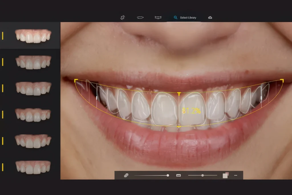 Как подготовиться к установке виниров? Этапы диагностики и Smile VR