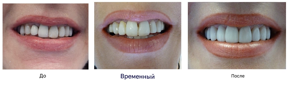 На изображении показано, как выглядят зубы до — с временными винирами, и после установки постоянных виниров