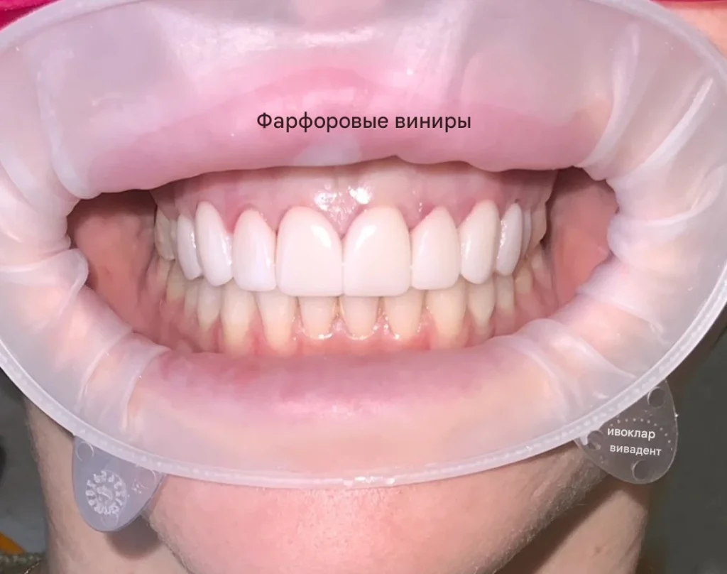 Финальный этап — фарфоровые виниры