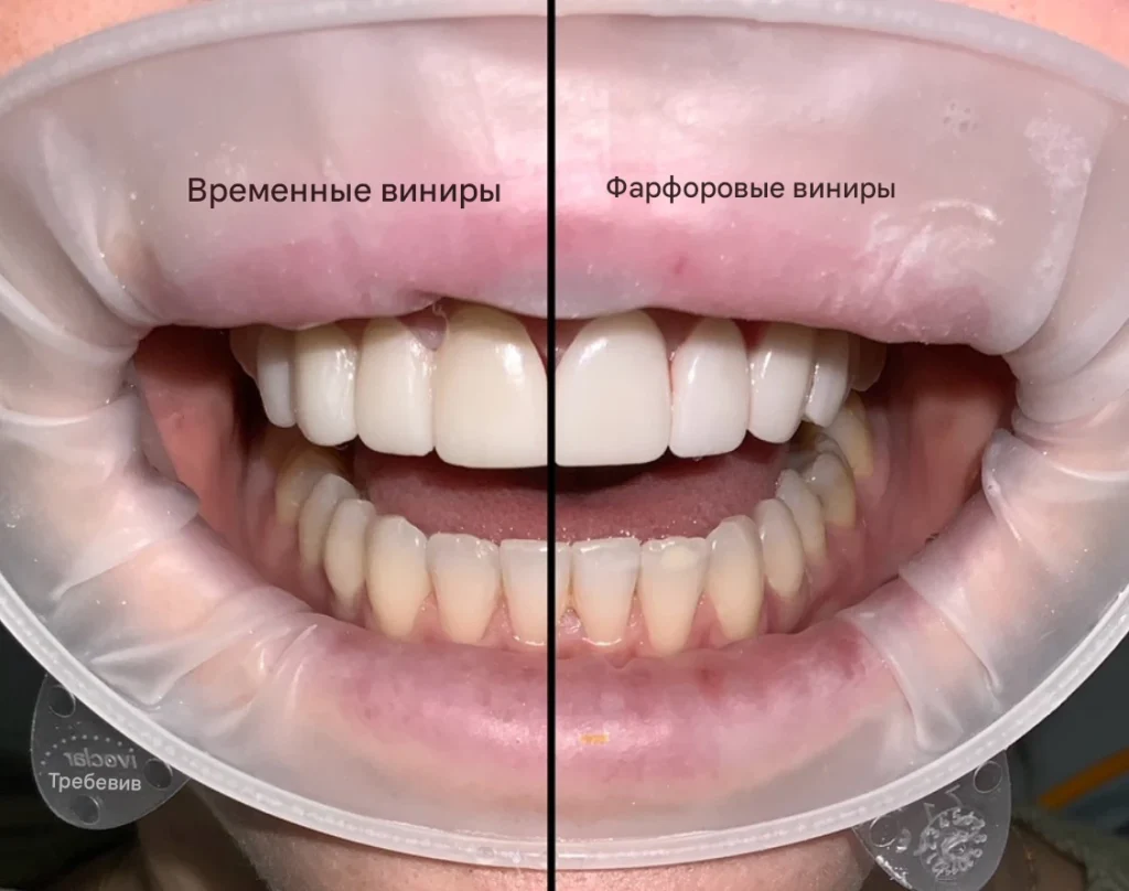 Временные виниры против фарфоровых виниров