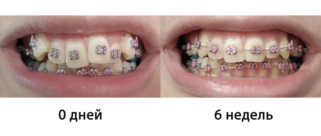 Фото пациента с брекетами через 6 недели