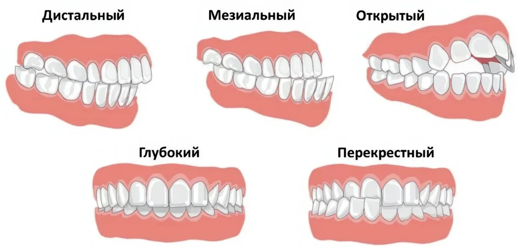 Нарушение прикуса