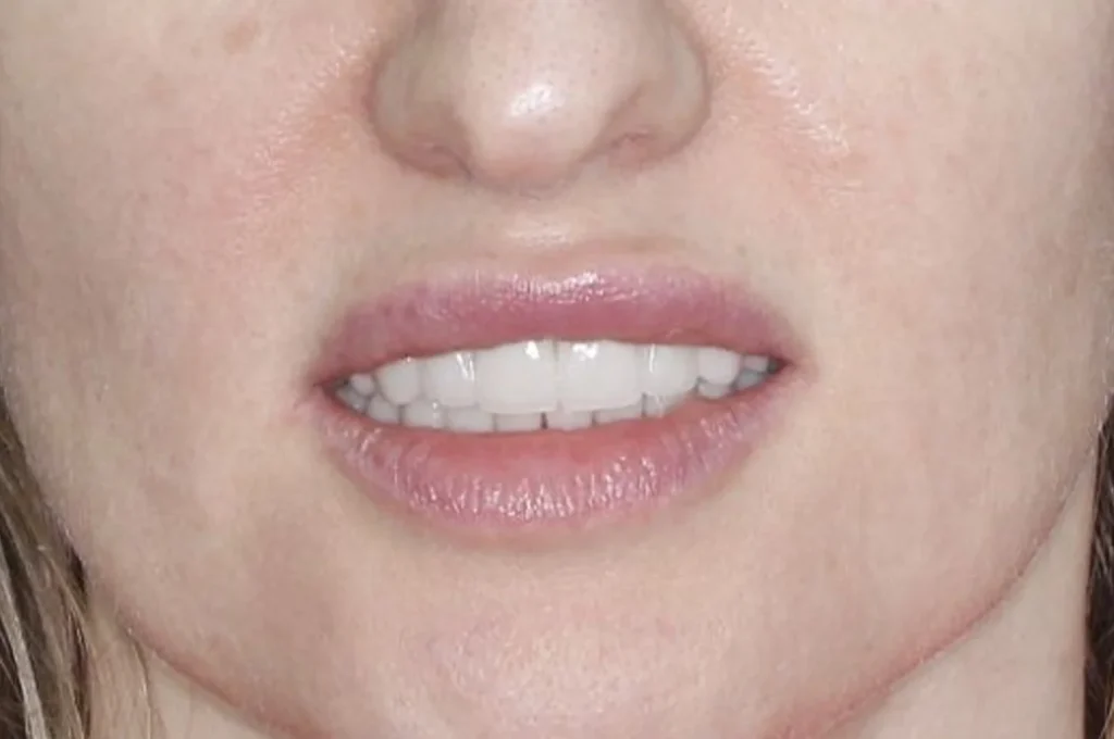 Керамические виниры E.max с художественной индивидуализацией