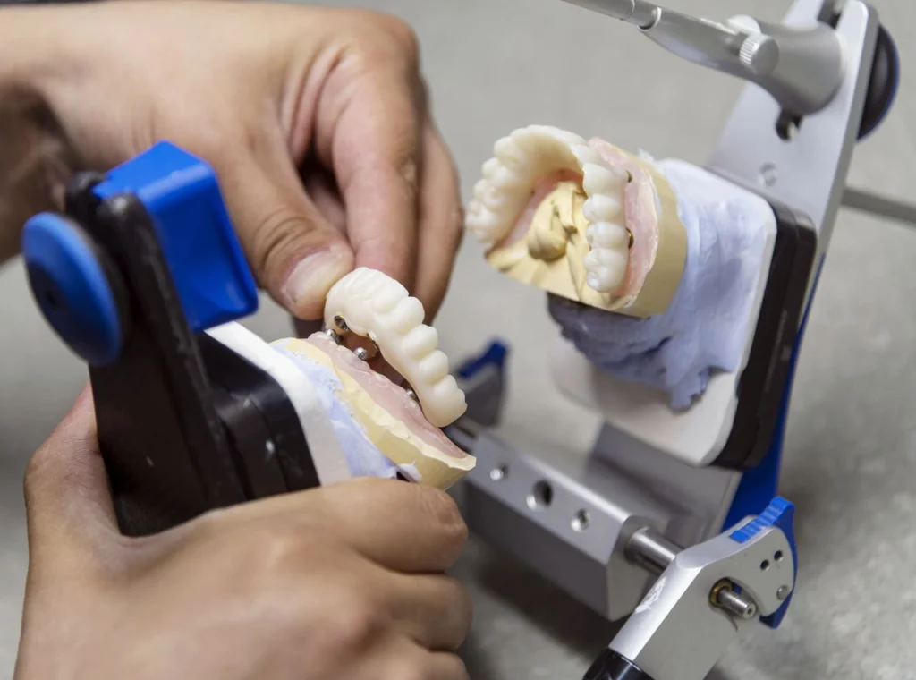 На фото — этап примерки и фиксации протезной конструкции на имплантатах в зуботехнической лаборатории