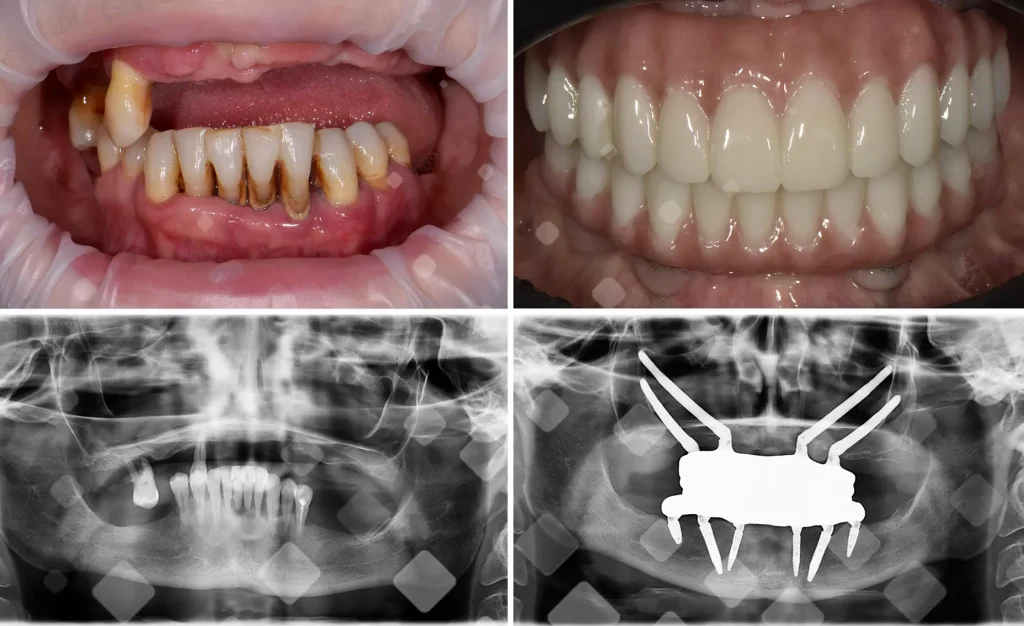 До и после имплантации зубов